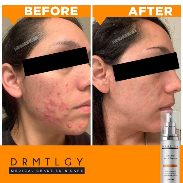 drmtlgy 24-hour spot acne serum sanwarna.pk