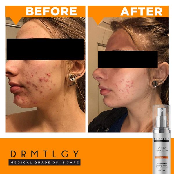 clean and clear acne spot treatment price in pakistan